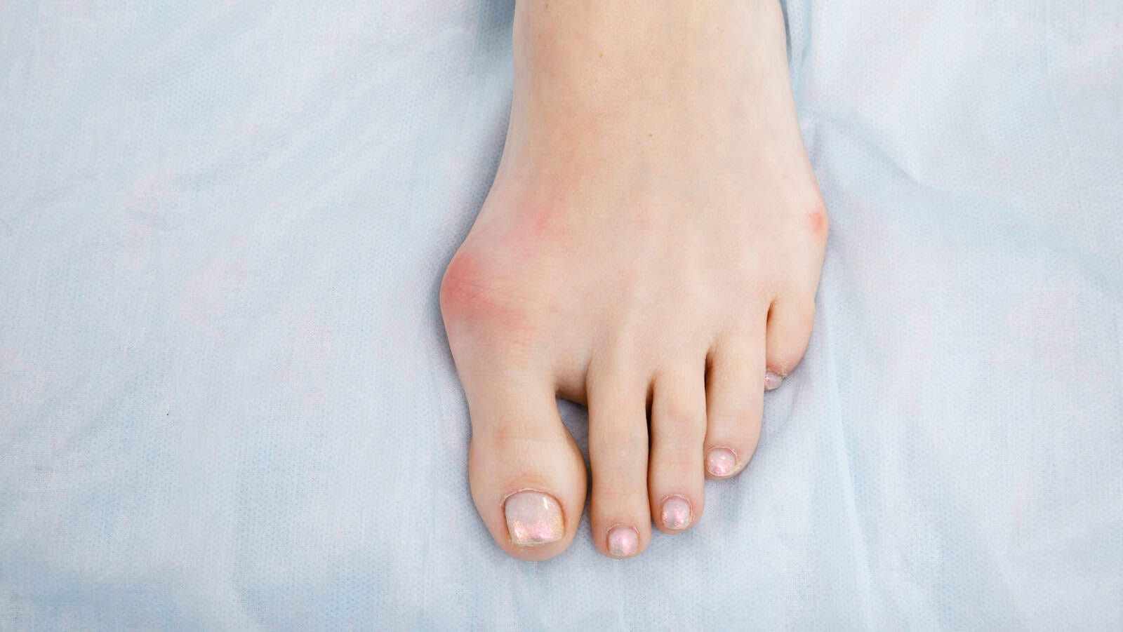 Painfully swollen toe with redness and swelling, possibly gout or injury.