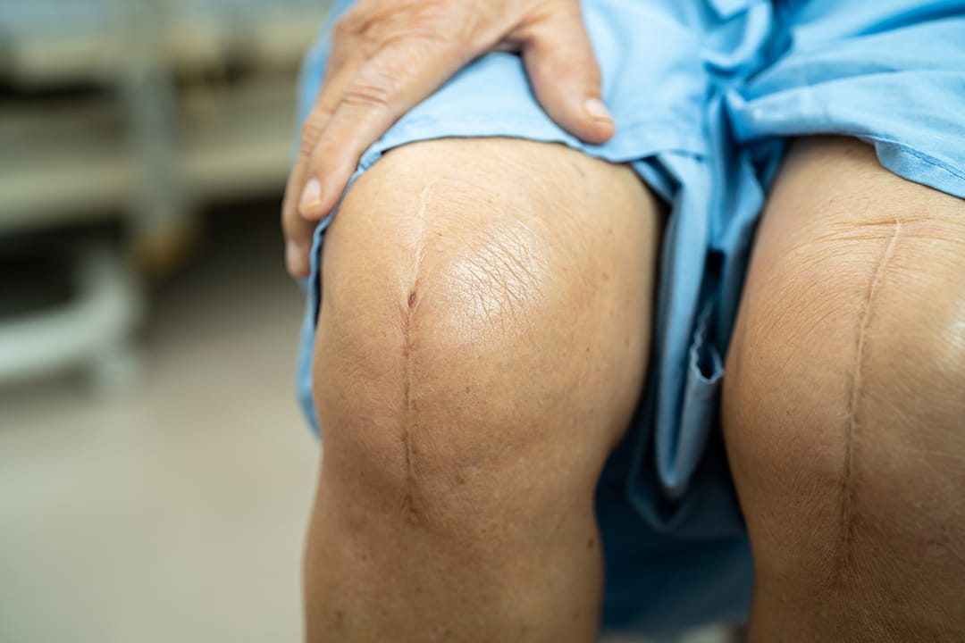 Close-up of a healed surgical scar on a patient’s knee after knee replacement, illustrating recovery and outcomes from total or partial knee replacement performed at Dr. Burke Orthopedics in Houston.